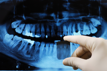 רשלנות רפואית עקירת שיניים