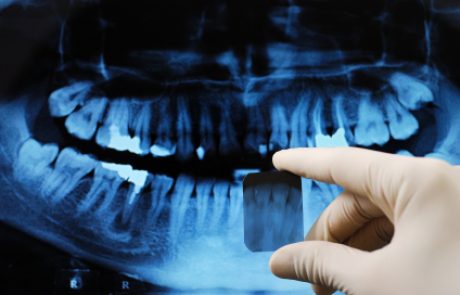 רשלנות רפואית בעת עקירת שיניים