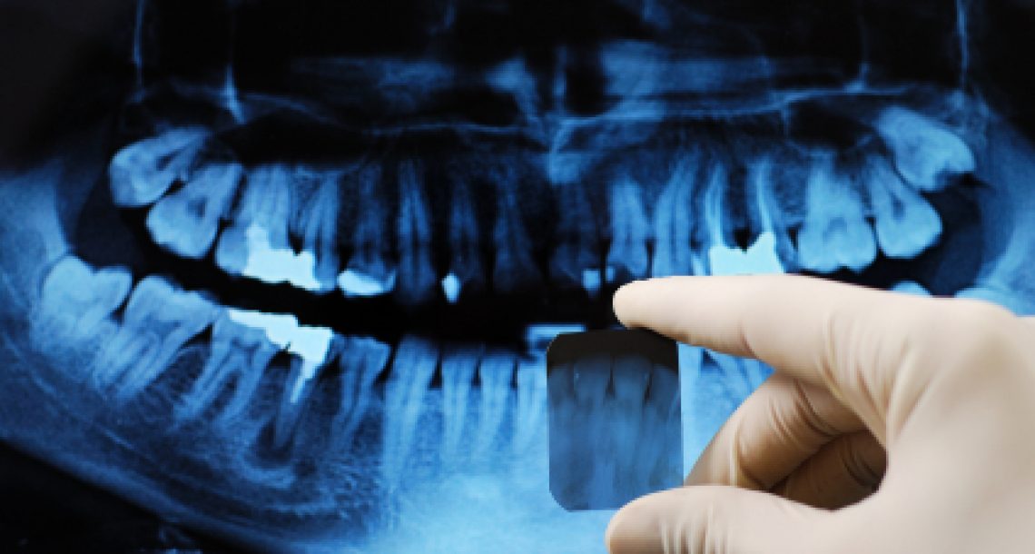 רשלנות רפואית בעת עקירת שיניים